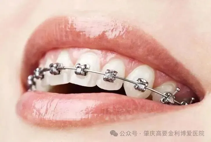 自锁式矫正器.jpg