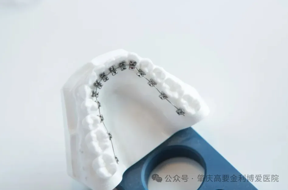 舌侧隐形矫正器.png